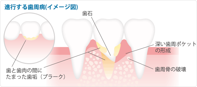 進行する歯周病(イメージ図)