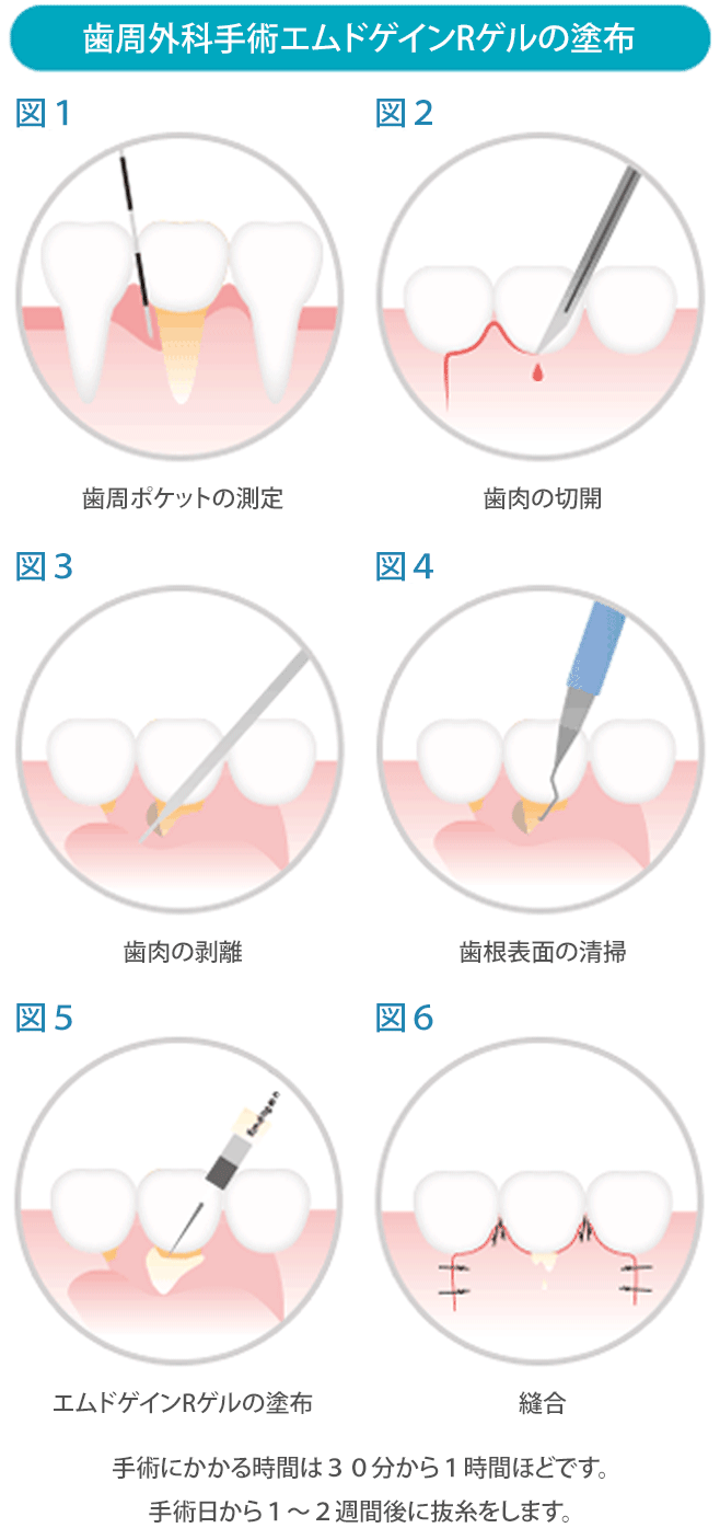 歯周外科手術エムドゲインRゲルの塗布